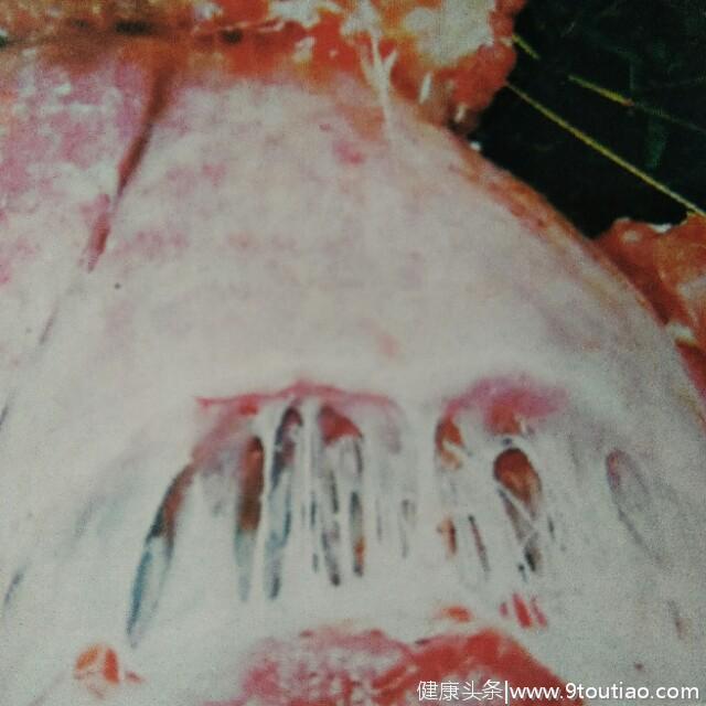 猪传染性胸膜肺炎