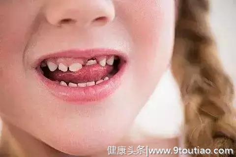 20种儿童牙颌畸形，12岁前必须处理！家长不要失职毁了孩子前程