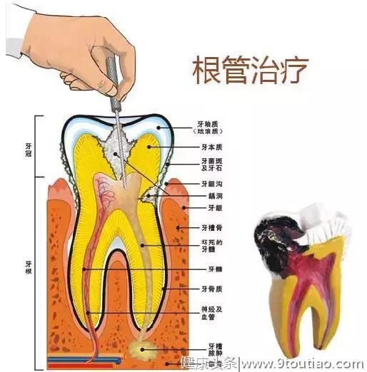 我怕牙医，但我不得不做根管治疗