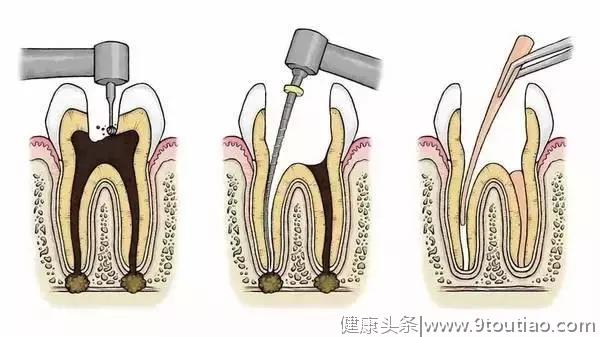 我怕牙医，但我不得不做根管治疗