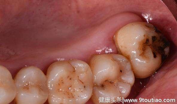 导致牙疼的七大根源性问题被找出，你反复牙疼就是它害的！
