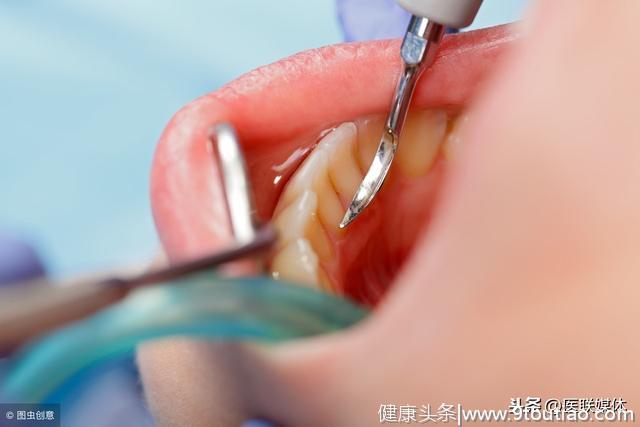 长满牙结石都抠不掉？医生：2种办法清除，牙齿干净了不少