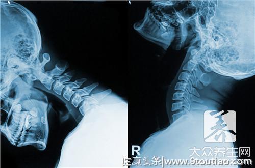 如何治疗颈椎病
