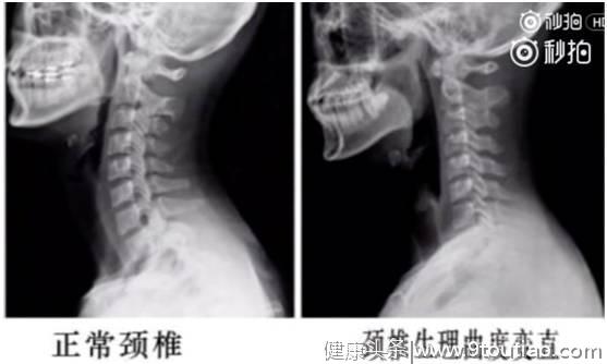 颈椎不好的看过来 5个动作教你矫正颈椎曲度