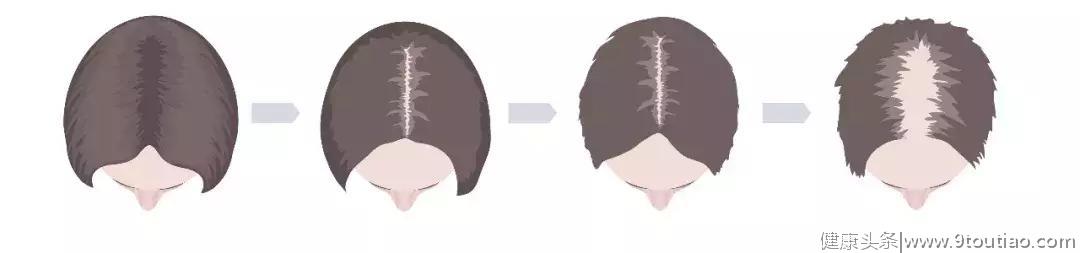 植一根头发需要30元，即使脱发不伴随具体的痛感，必须引起重视