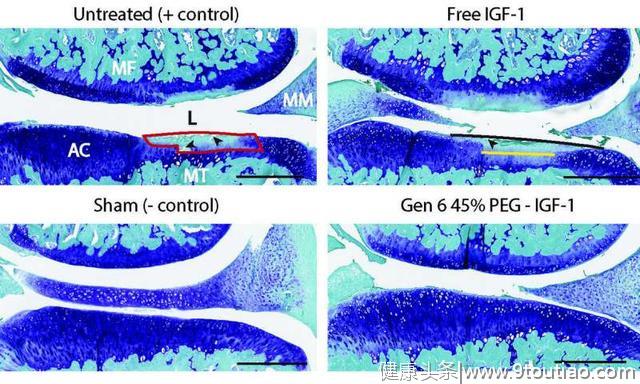 潜在的关节炎治疗可防止软骨破坏