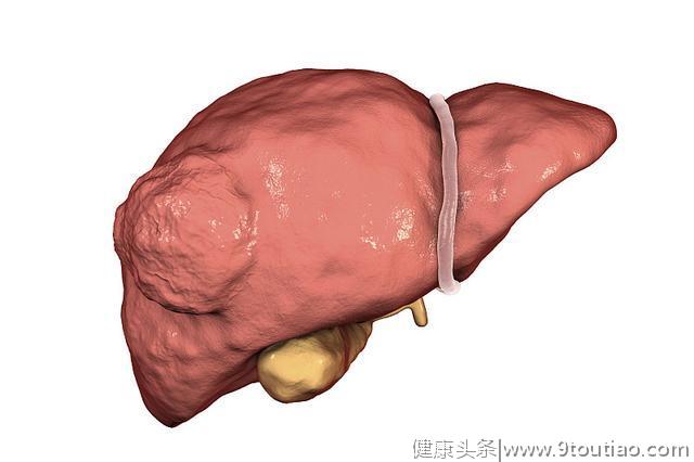 夫妻俩滴酒不沾，却都查出肝癌，医生：3样东西扔掉别吃，太伤肝