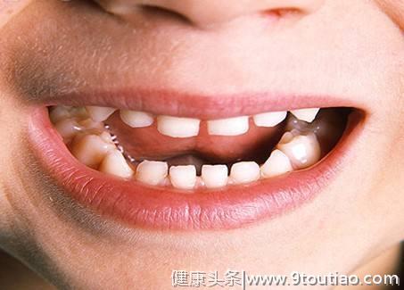 导致儿童“六龄齿”及多颗牙齿坏掉，大部分家长都会犯的错！