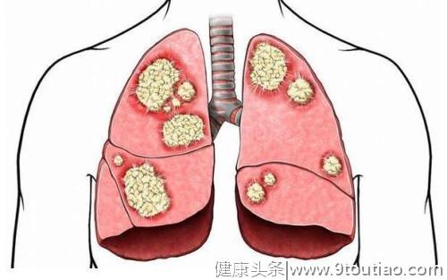 肺癌--常见的“杀手”，我们需要注意的肺癌可疑症状有哪些？