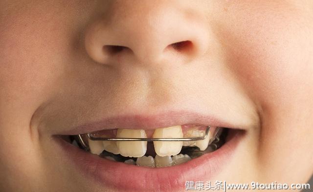 成年后，还可以矫正牙齿吗？看完可能对你有帮助！