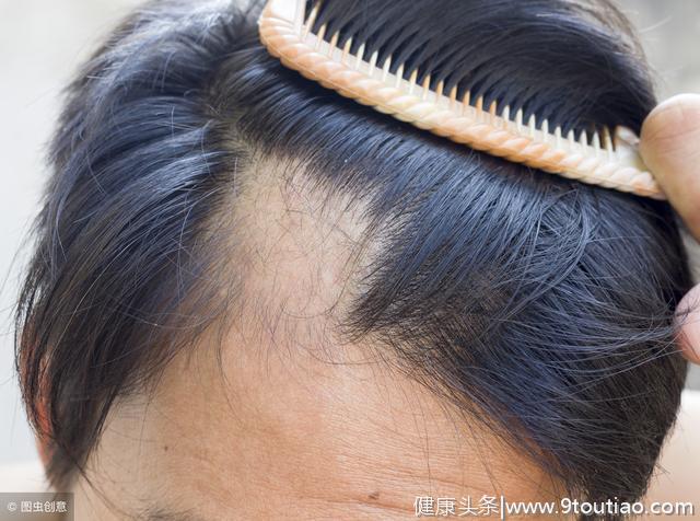 面对过度的掉发，我们该如何预防脱发？