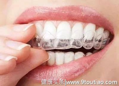 谁说整牙的都是“钢牙妹”，牙套的装备可不止这一种！