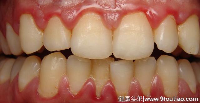 粉嫩的健康的牙龈是真实存在的吗？