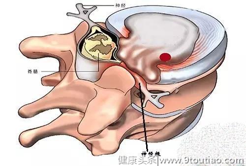 什么是神经根型颈椎病？要怎样预防