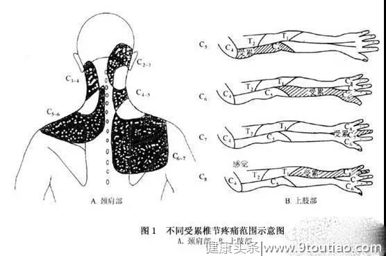 什么是神经根型颈椎病？要怎样预防