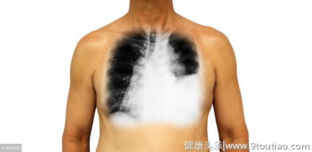 照照胸片就能早早发现肺癌？错！它才是正确的选择