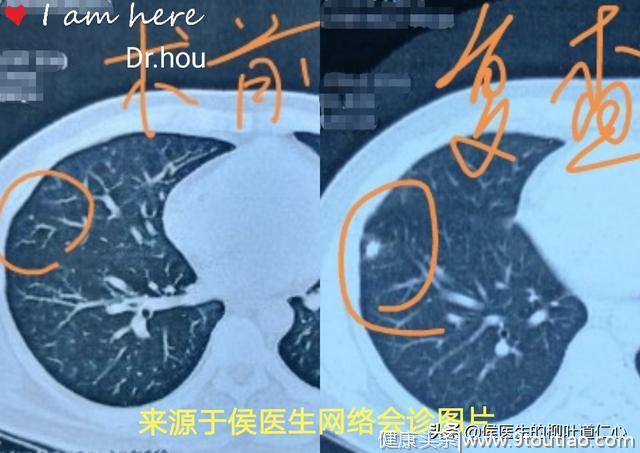 Ia1期“微小肺癌”术后，复发和转移的“锅”，谁来背？