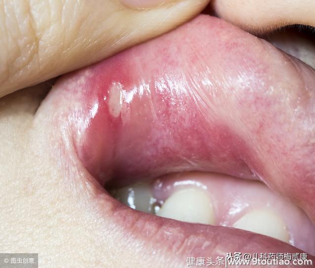口腔溃疡经常犯，有办法治疗吗？医生：先把肠道病治好！