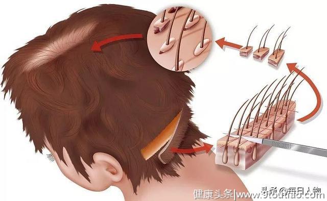中国脱发人群数量达2亿，植发真的能拯救中国人的发际线吗？
