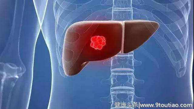 抗病毒治疗对于乙肝相关性肝癌的重要意义