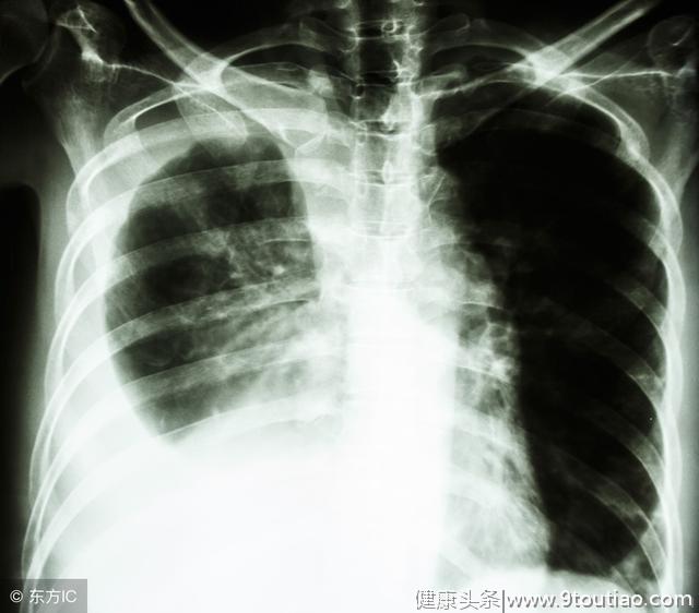 这里疼可能是肺癌信号，当心肺癌三个不典型症状