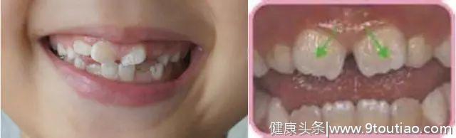 孩子有多生的牙齿，需要拔掉吗？#葉子口腔科普#