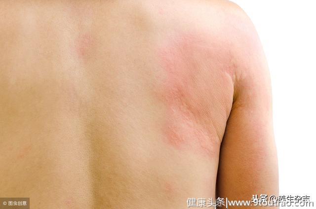 小伙长期皮肤瘙痒长红斑！医生提醒：这种过敏，严重可致命！