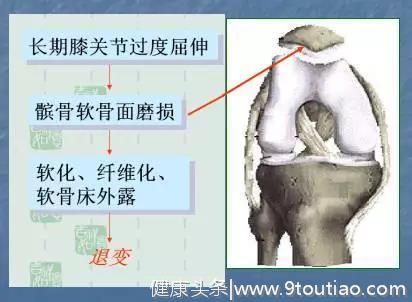 膝骨性关节炎的康复治疗.