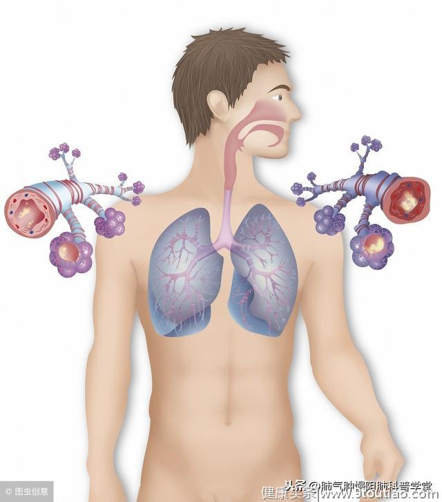 肺部炎症在慢阻肺发病机制中作用？与哮喘的气道炎症有哪些区别？