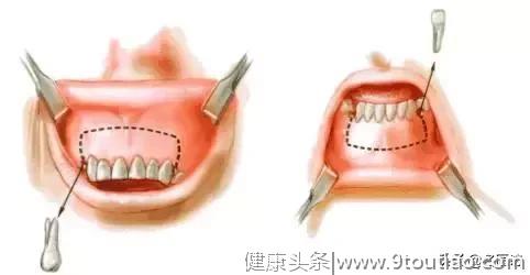 # 牙齿矫正科普|为何做了牙齿矫正，牙齿还是龅牙！