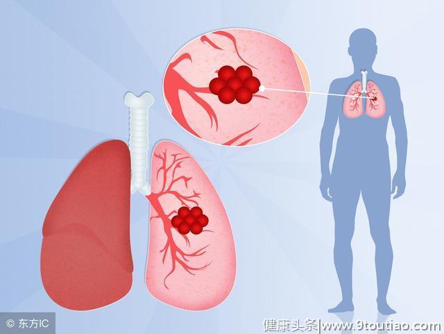 肺癌为何常常发现晚，早期肺癌有6个症状