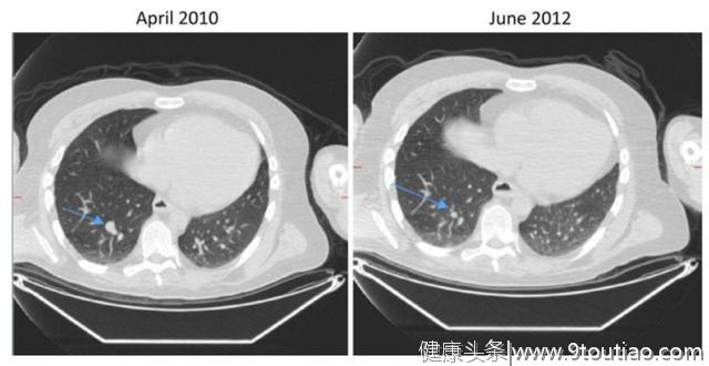 6年前诊断肺癌被告知仅剩一年生命，如今癌症消失！他如何治疗的