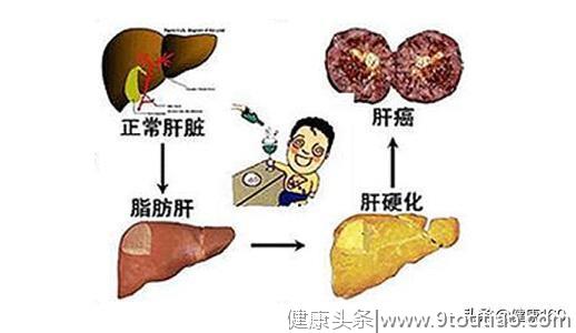 脂肪肝会发展成肝癌，这4种人最容易得，医生教你轻松告别它