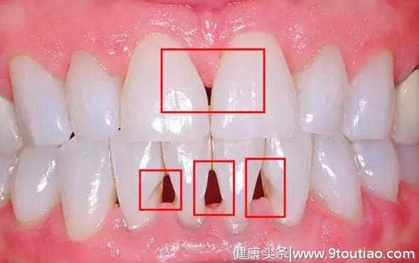 济宁丁香树口腔医院告诉你：牙齿的黑三角，比蛀牙更可怕