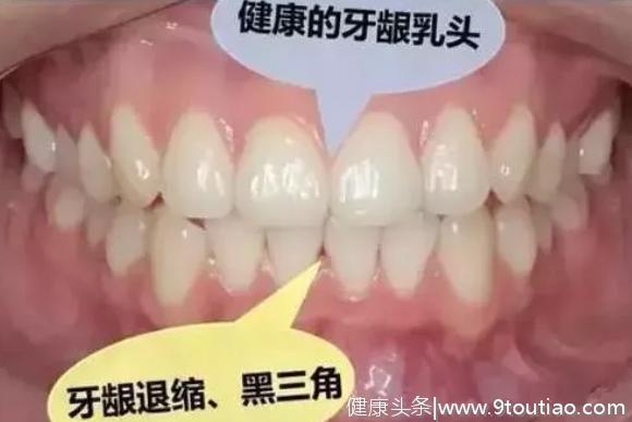 济宁丁香树口腔医院告诉你：牙齿的黑三角，比蛀牙更可怕