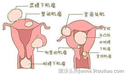 不同位置的子宫肌瘤对怀孕的影响！