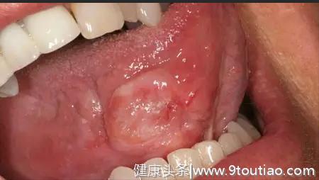 口腔10大常见疾病表现
