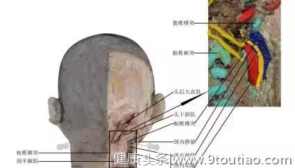 最新版头痛（颈源性头痛）中医诊疗方案