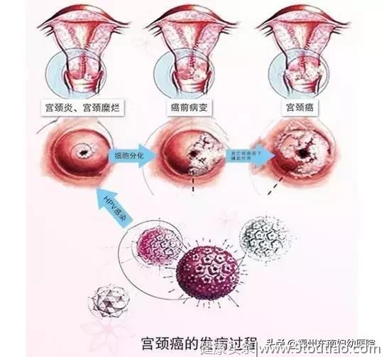 宫颈癌离我们有多远