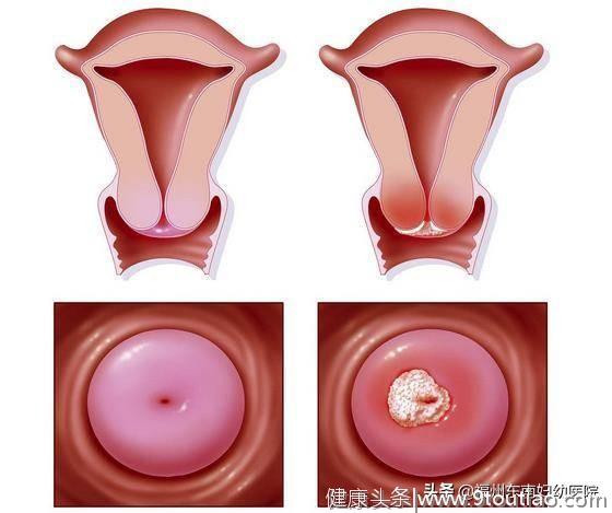 宫颈癌离我们有多远