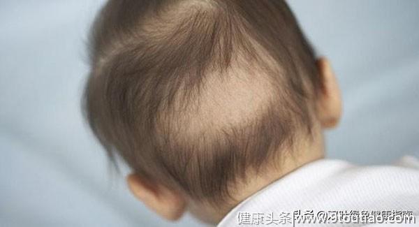父母需要了解婴儿脱发的原因