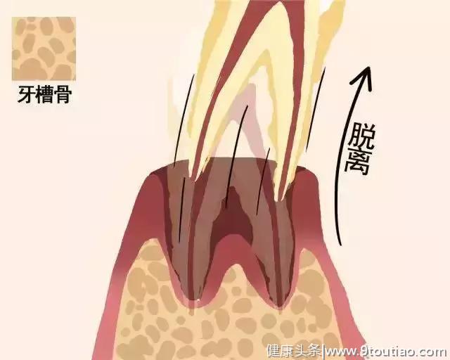 牙齿脱落全过程，看了你就清楚了