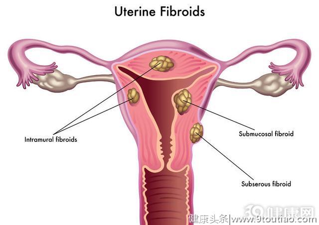忘了提醒你：不想得子宫肌瘤，有4个细节要注意