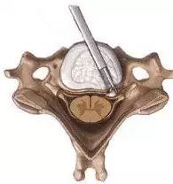 在日本，颈椎椎间盘突出不一定非得做“金属融合术”