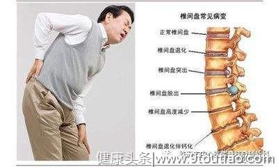 腰痛伴下肢痛到底是怎么回事？