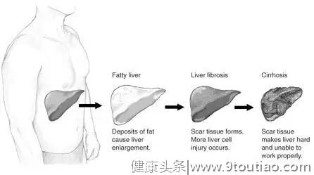 体检查出脂肪肝，除了减肥，还要注意什么？