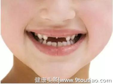 乳牙早失——儿童隐形的颜值杀手
