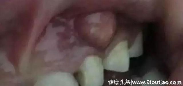 那个没有补的蛀牙小黑点，后来怎么样了？#葉子口腔科普#