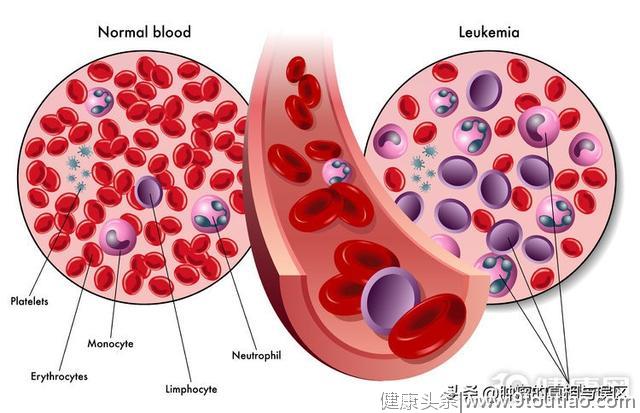 预防白血病，其实很容易，6个诱因离远点就行了