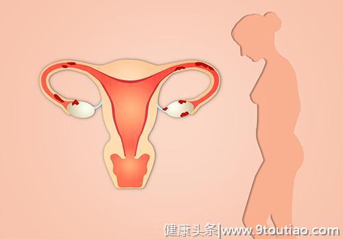 子宫肌瘤想早期发现还得靠自己！4点症状你身上有吗？